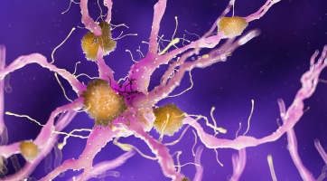 Találtak egy új gyógyszert, ami lassítja az Alzheimer-kórt